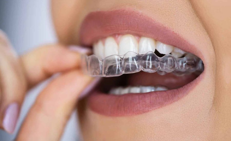 Align Technology Share Price 100$ 400$ Invisalign Cost Costco, Performance & More 2 Align Technology’s Stock Performance And The Impact On Invisalign: